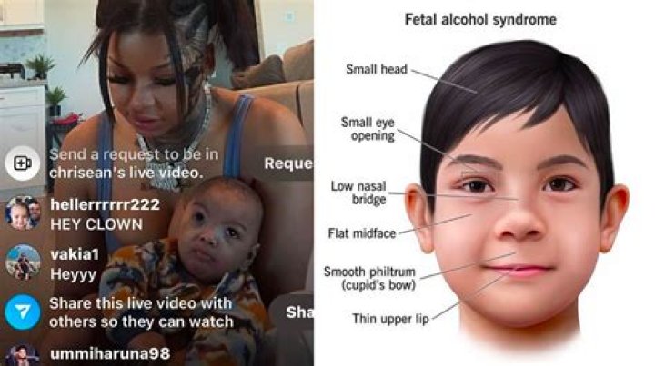 Concealed Truths: Fetal Alcohol Syndrome's Impact On Celebrities