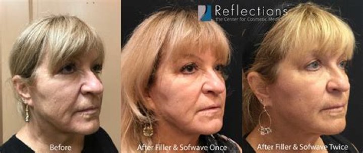 Susan Page's Facelift: Before And After Photos